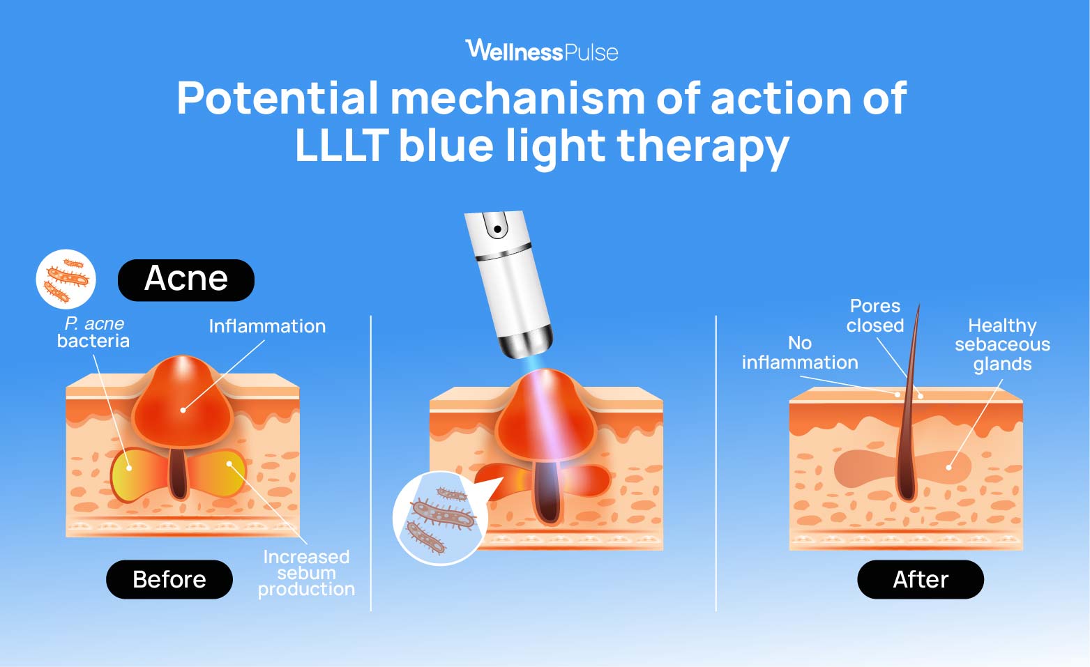 Infographic showing the potential benefit for acne using LLLT