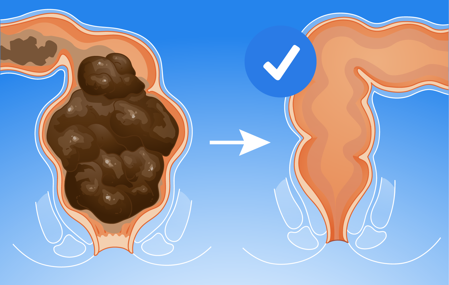 Infographic showing how probiotics improve constipation