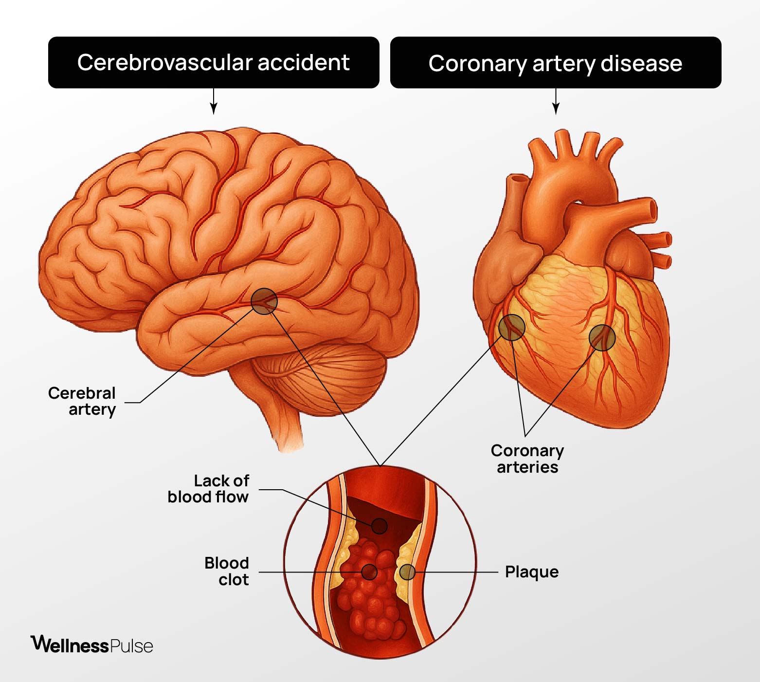 Illiustration showing how Cerebrovascular and Coronary artery disease look