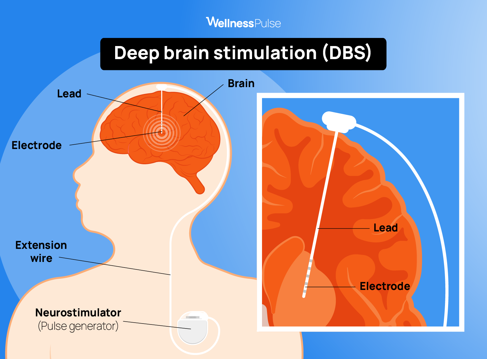 Illustration showing how Deep brain stimulation (DBS) looks