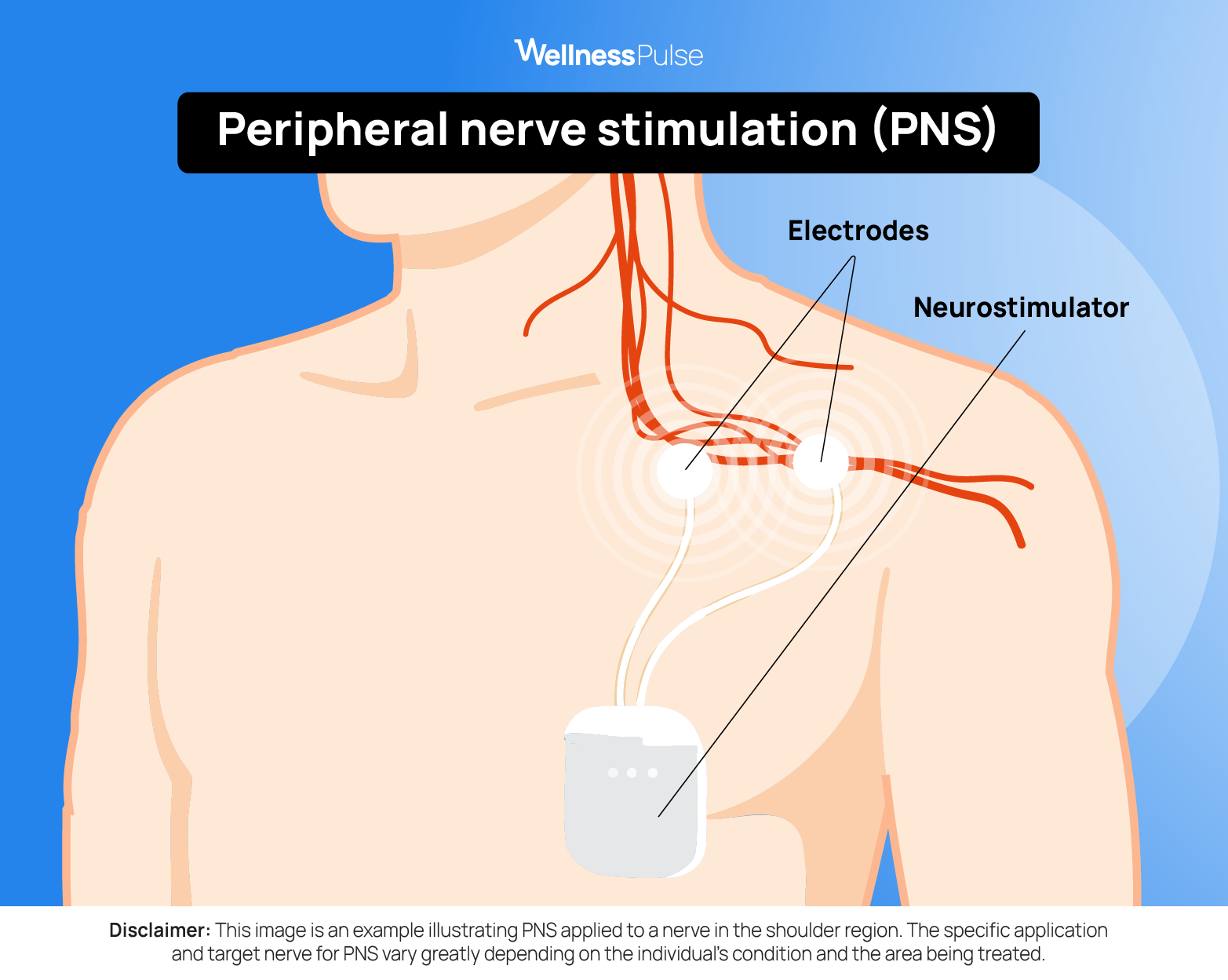 Illustration showing how Peripheral nerve stimulation (PNS) looks