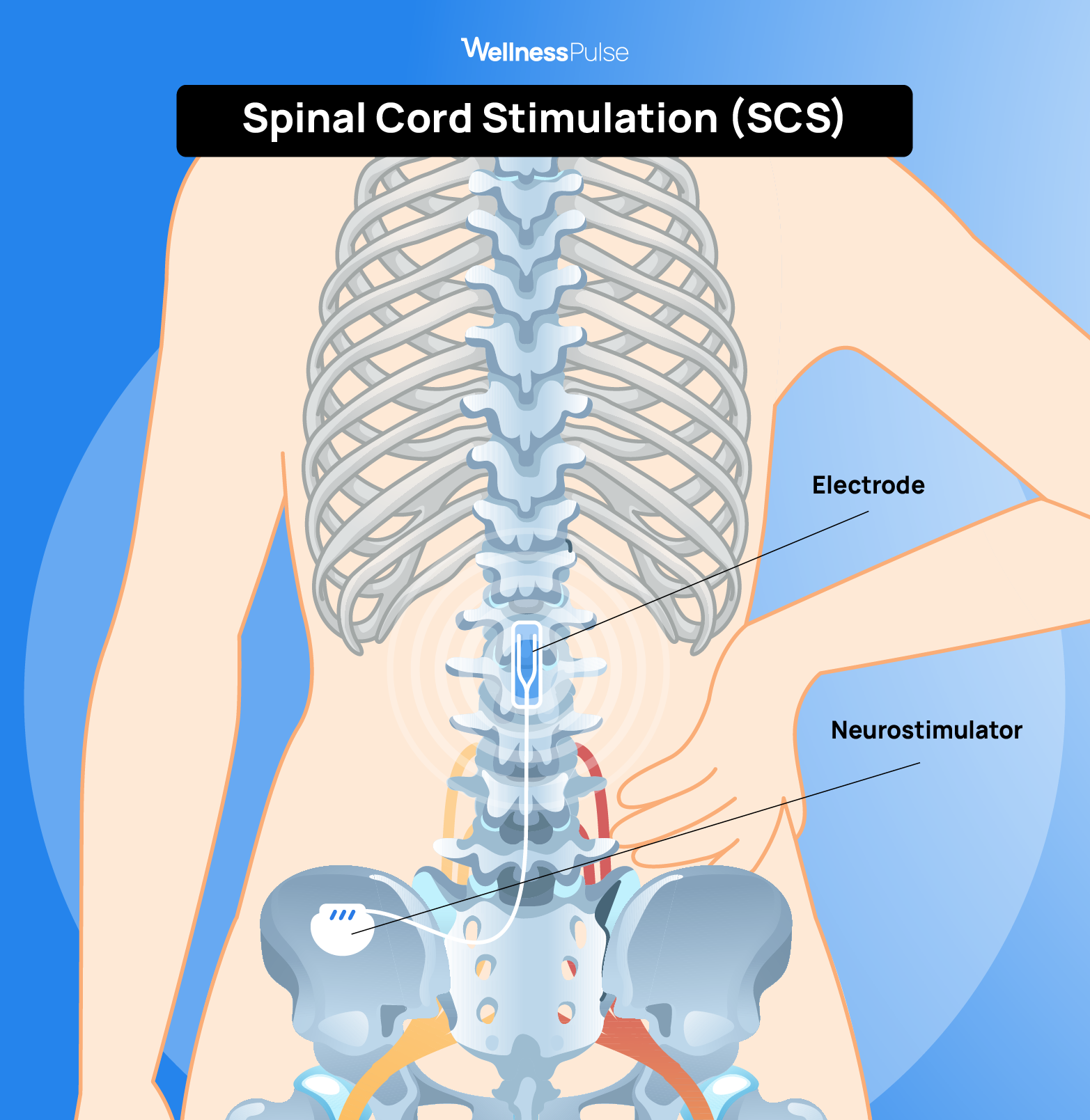 Illustration showing how Spinal cord stimulation (SCS) looks