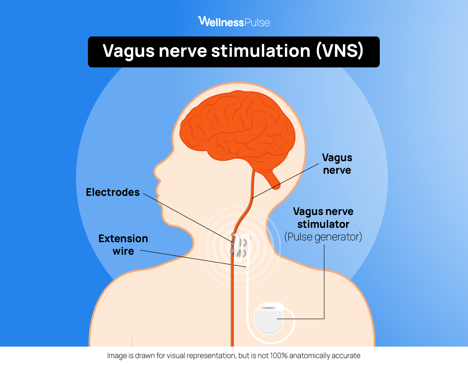 Illustration showing how Vagus nerve stimulation (VNS) looks