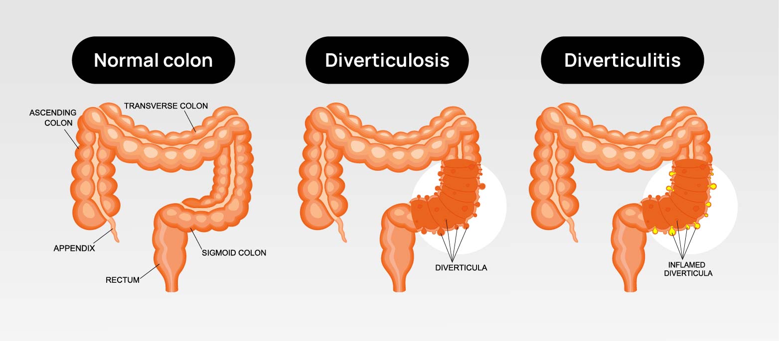 Illustration showing how diverticulosis and diverticulitis look like