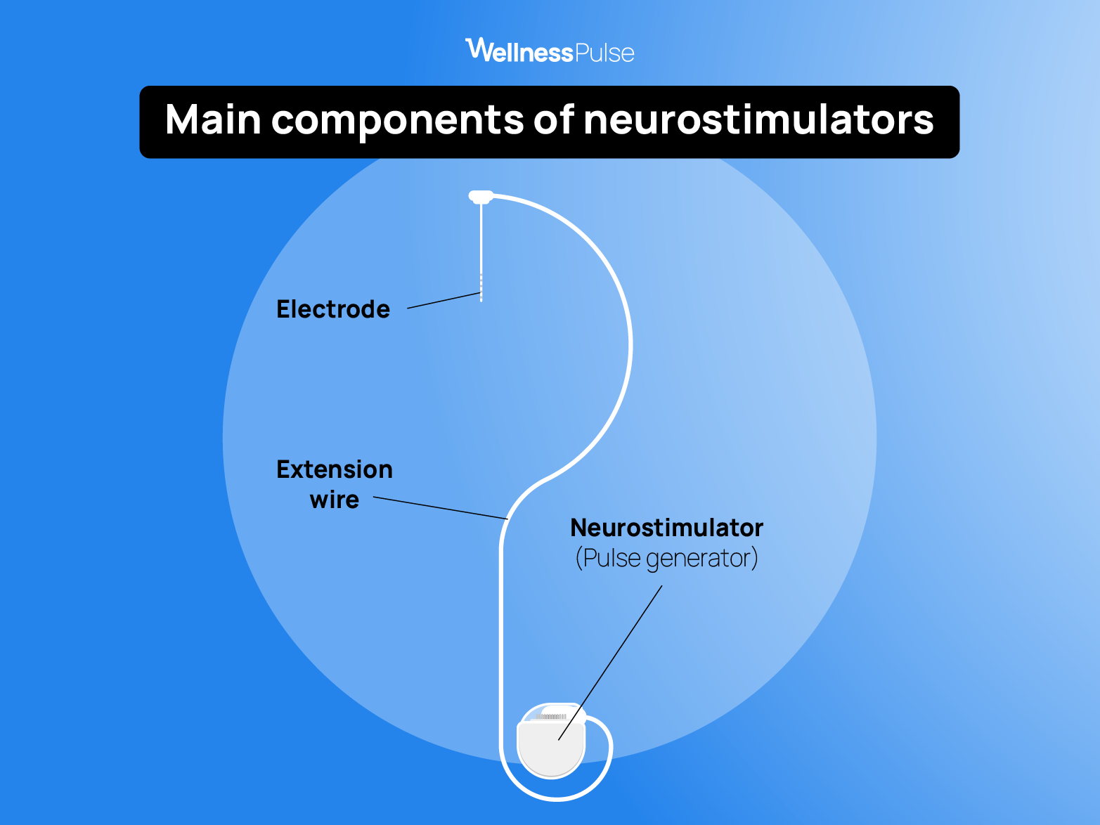Illustration showing how neurostimulators work and their main components