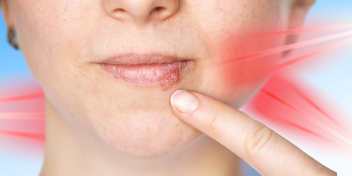 Person pointing to a cold sore with red light therapy aimed at the area